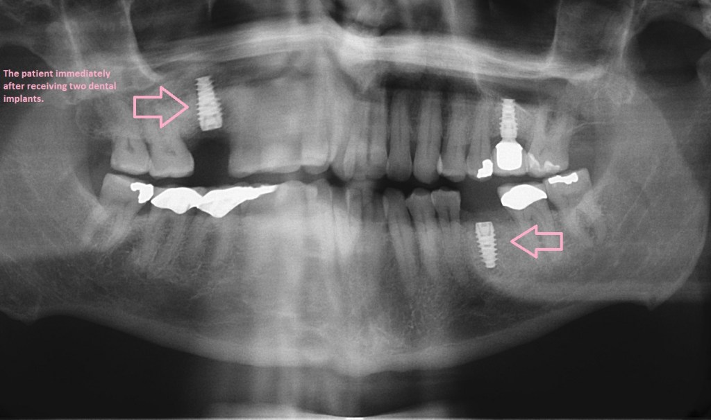 Panoramic x-ray after two dental implants were placed
