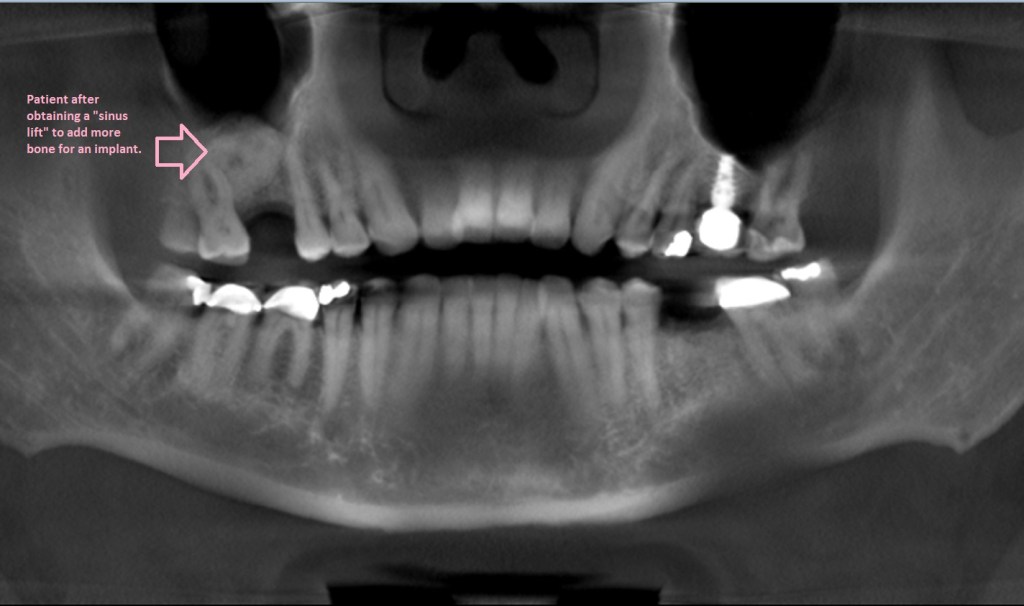 Panoramic x-ray after sinus lift and socket preservation