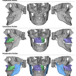 Smile Gallery Implants