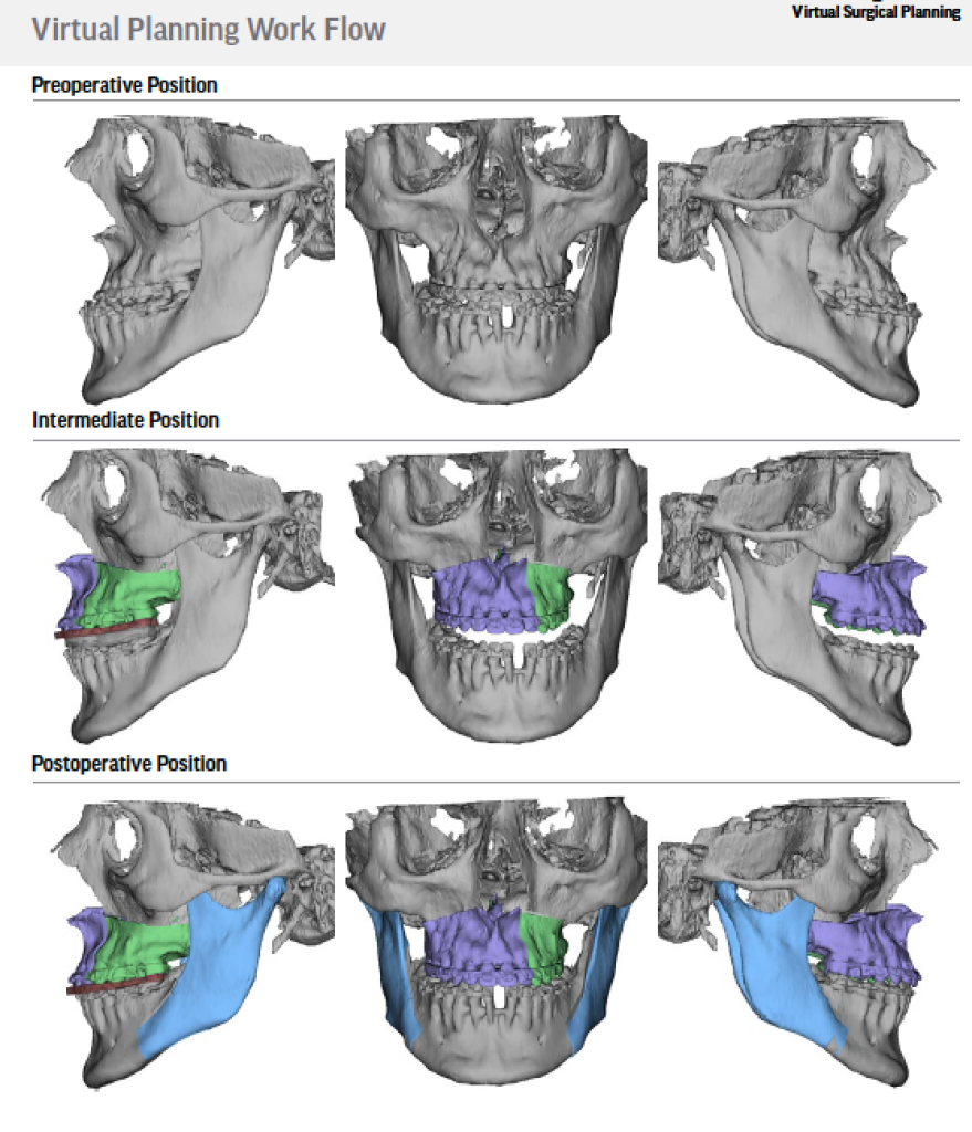 Smile Gallery Implants