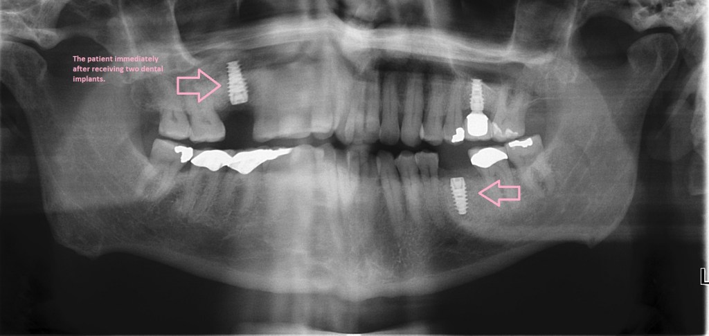 Implants Smile Gallery