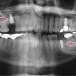 Implants Smile Gallery