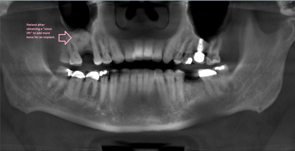 Smile Gallery Dental Implants