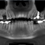Smile Gallery Dental Implants