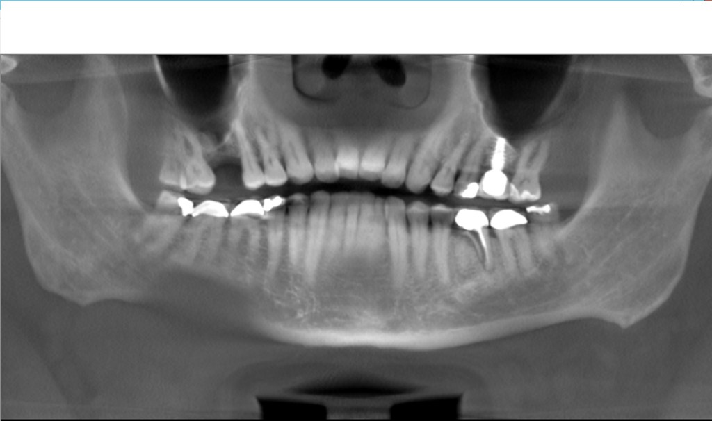 Dental Implants Smile Gallery