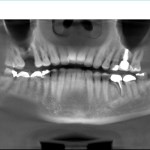 Dental Implants Smile Gallery